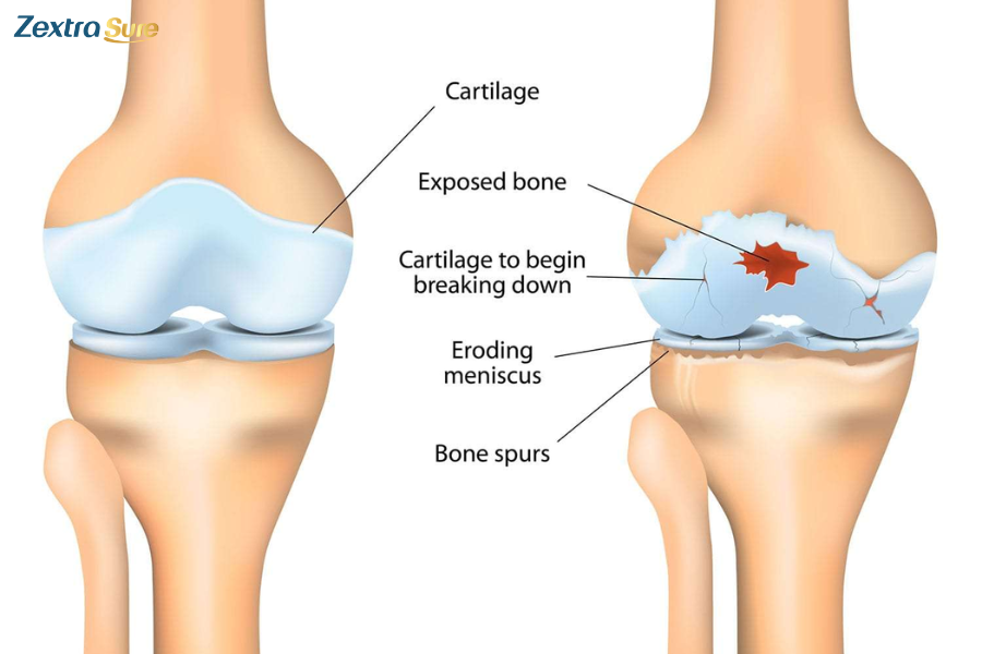 Osteoarthritis is a degenerative disease that often results in chronic pain